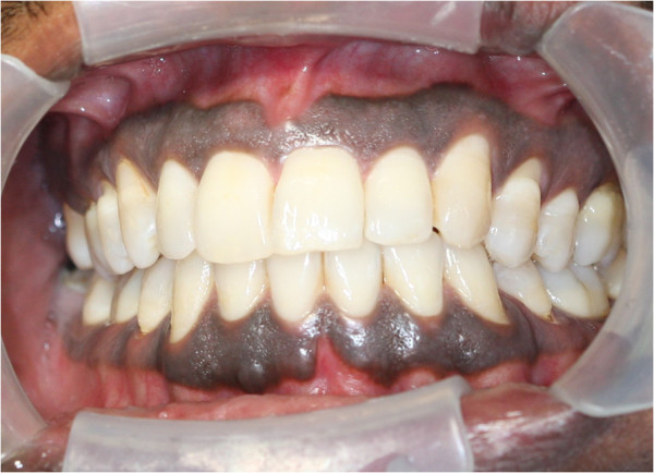 physiologic pigmentation